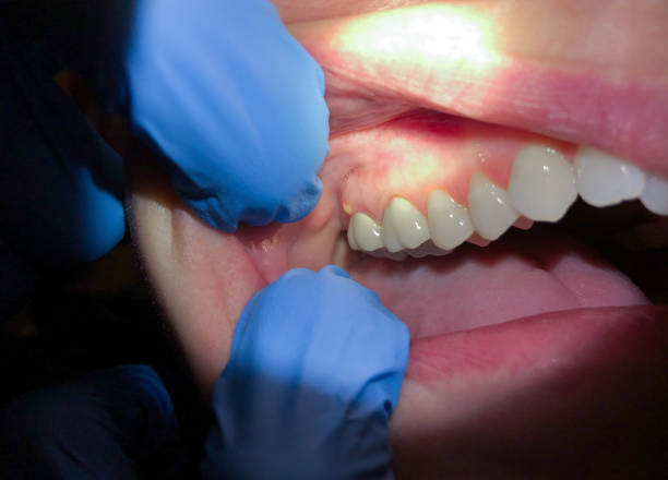 Best Emergency Gum Treatment in Ontario, OH